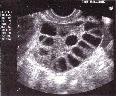 Ovario poliquistico
